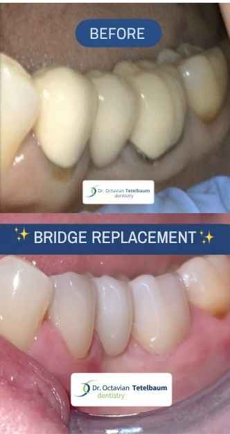 Before and after dental bridge replacement in London Ontario