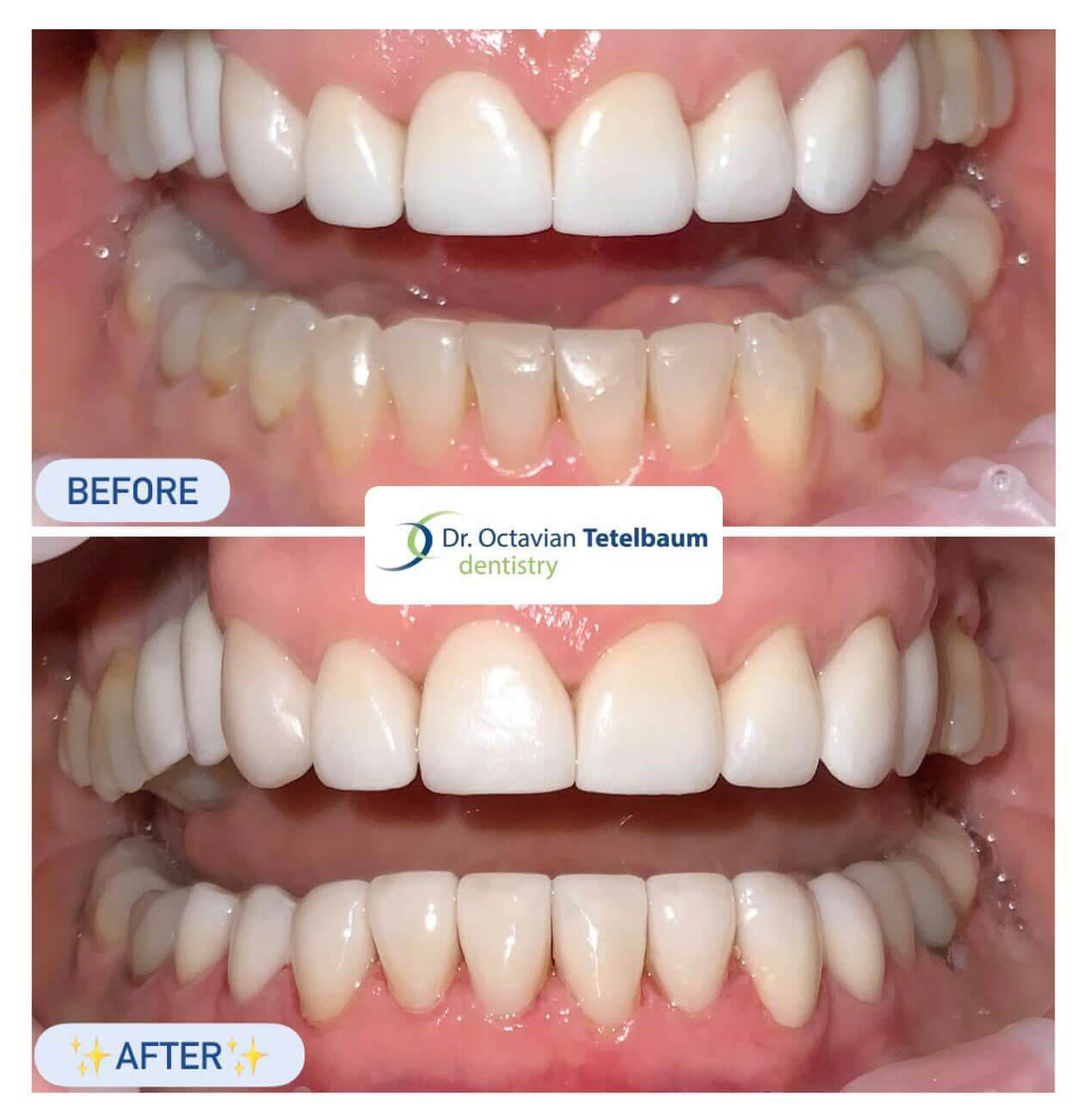 Before and after porcelain crowns and veneers treatment in London Ontario