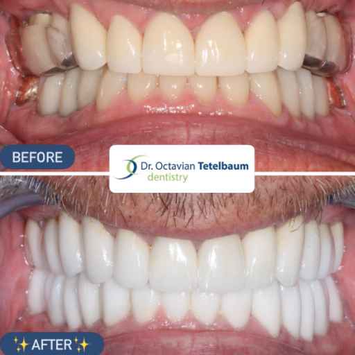 Before and after full mouth reconstruction with ceramic restorations