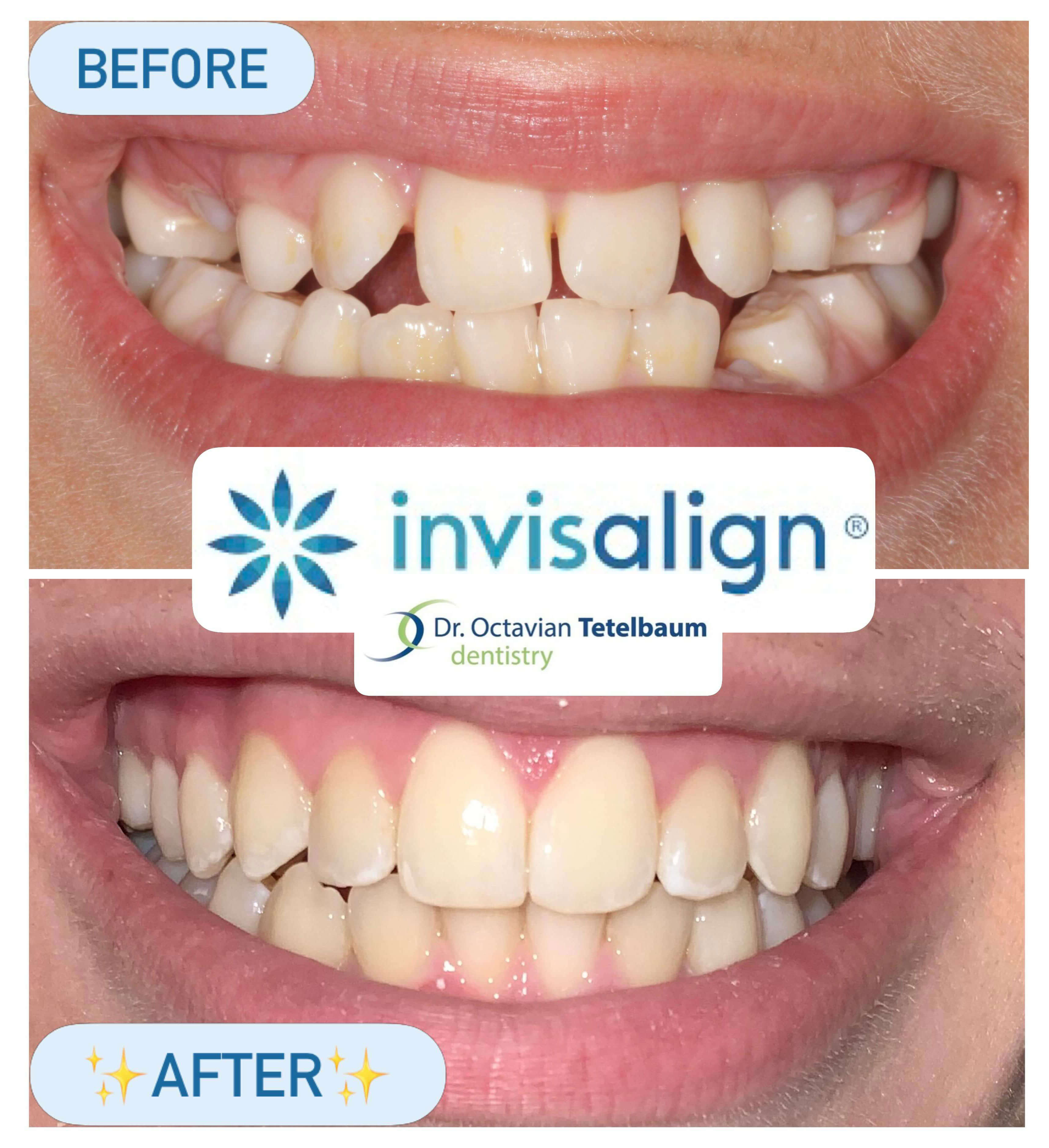 Before and after teen Invisalign treatment at Synergy Centre Dental