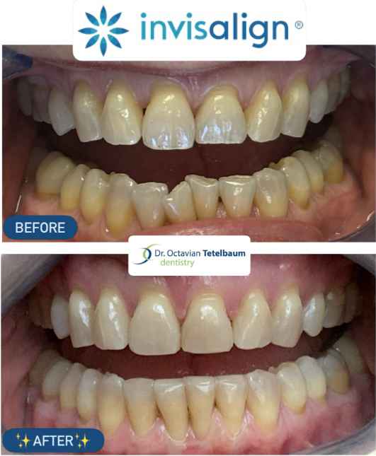Invisalign before and after showing improved tooth alignment and bite in London Ontario