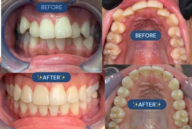 Before and after Invisalign treatment for crowded teeth at Synergy Centre Dental