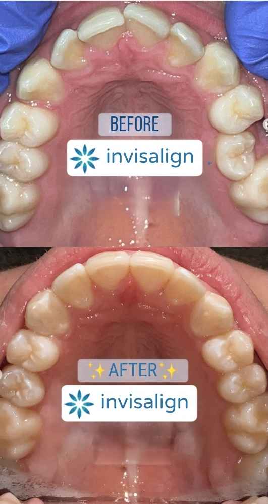 Before and after Invisalign treatment for tooth rotation in London Ontario