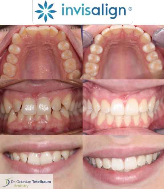 Before and after Invisalign tooth straightening treatment in London Ontario